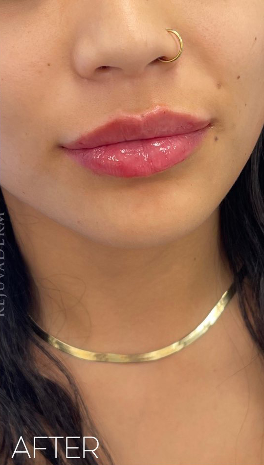 After Image: Lip Filler - right-front-oblique