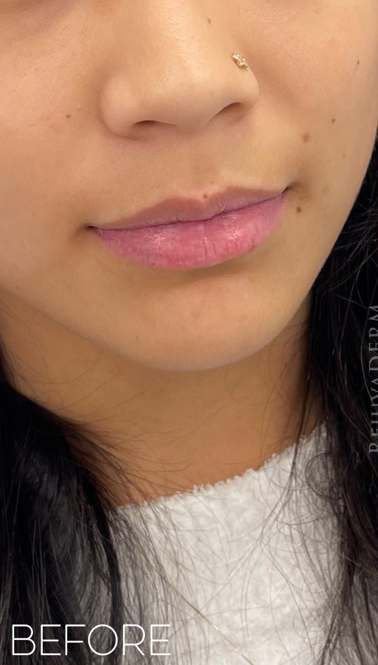 Before Image: Lip Filler - right-front-oblique